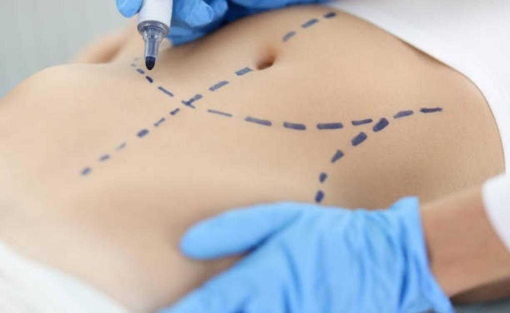A cirurgia plástica entrou na era dos detalhes: por que o umbigo se tornou uma das maiores preocupações de quem faz abdominoplastia